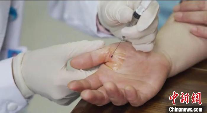 嘉善群眾體驗小針刀?！〖紊平y(tǒng)戰(zhàn) 供圖